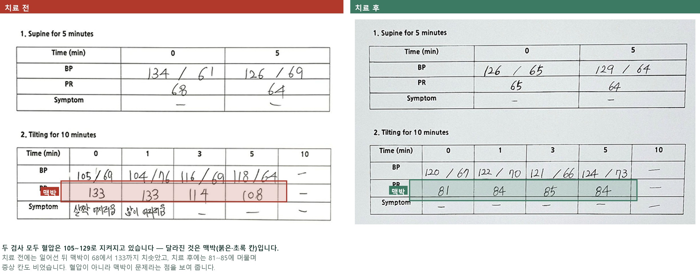 기립성빈맥증후군의 치료 전후 검사 기록 — 치료 전에는 일어선 뒤 맥박이 68에서 133까지 올랐고, 치료 후에는 같은 자세에서 81~85에 머물며 증상도 사라졌습니다