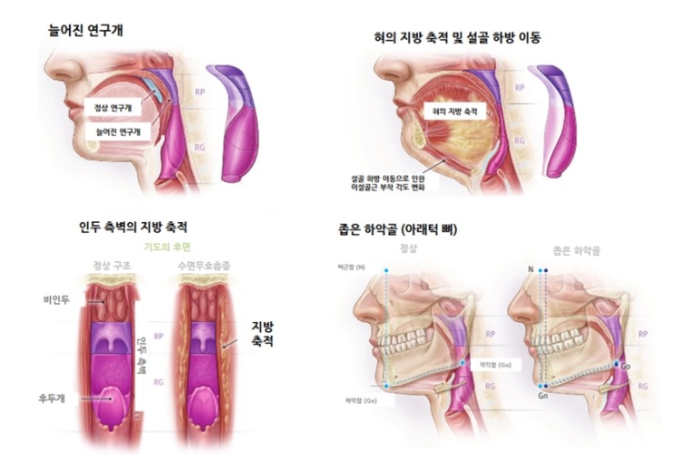 수면 중 기도 폐색의 네 가지 해부학적 원인 — 늘어진 연구개, 혀의 지방 축적과 설골 하방 이동, 인두 측벽의 지방 축적, 좁은 하악골