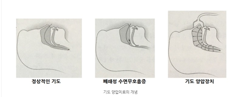 양압치료의 원리 — 정상 기도, 폐쇄성 수면무호흡증으로 막힌 기도, 양압장치로 열어 둔 기도
