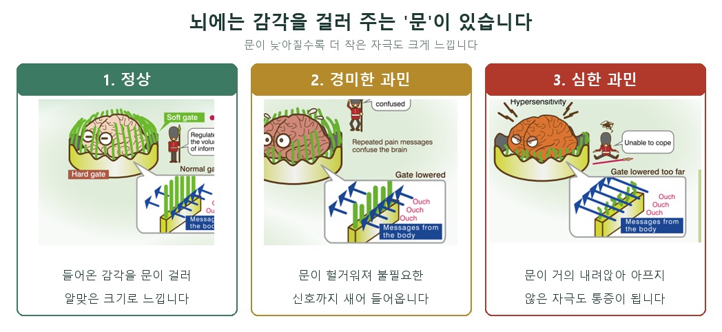 뇌의 감각의 문 세 상태 — 정상은 문이 감각을 걸러 알맞게 느끼고, 경미한 과민에서는 문이 헐거워져 불필요한 신호까지 들어오며, 심한 과민에서는 문이 거의 내려앉아 아프지 않은 자극도 통증이 됩니다