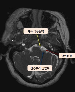 반측안면경련의 MRI — 얼굴 신경이 뇌에서 나오는 신경뿌리 진입부에서 척추동맥에 눌려 있는 모습