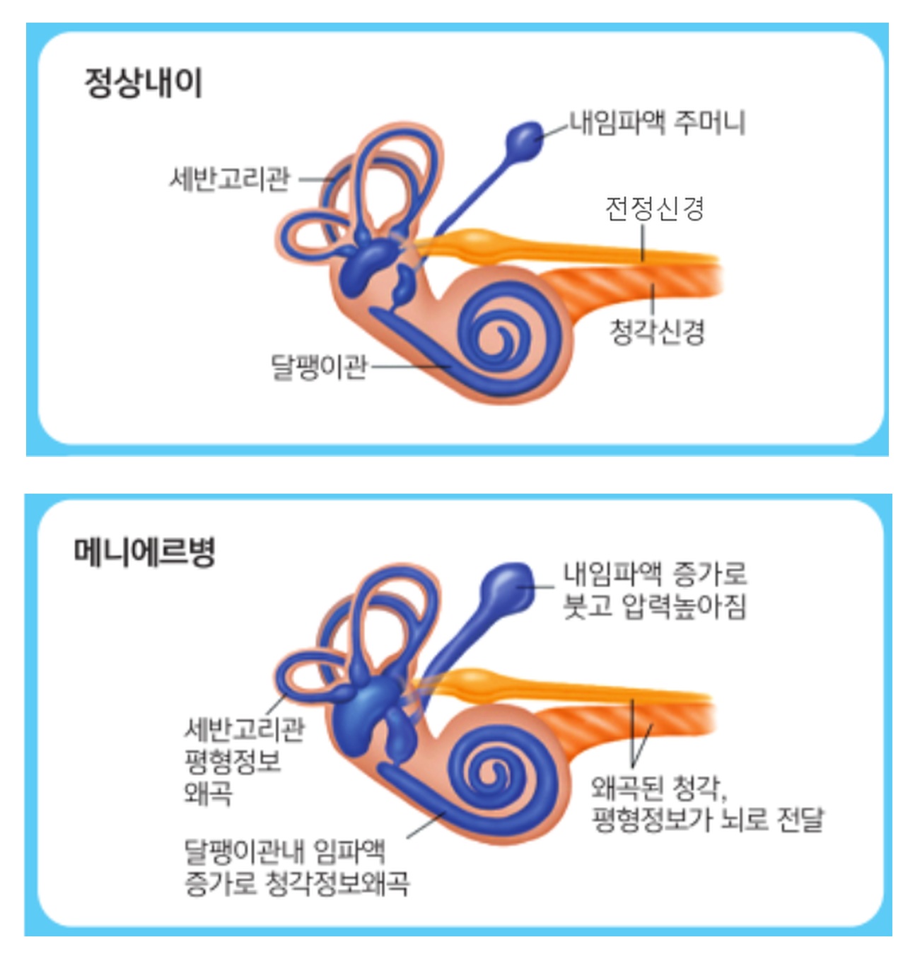 정상 내이와 내림프수종의 비교 — 속귀를 채운 림프액이 늘어 붓고 압력이 높아진 상태