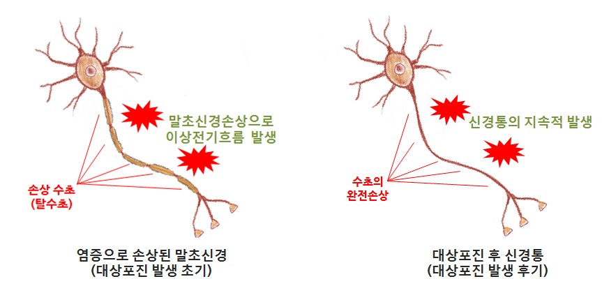 대상포진 초기의 신경 손상과 대상포진후 신경통의 비교 — 초기의 부분 손상이 회복되지 못하면 수초가 완전히 손상되어 신경통이 지속적으로 발생합니다