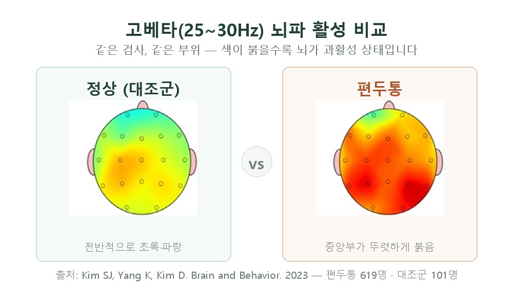 정상(대조군)과 편두통 환자의 고베타 뇌파 활성 비교