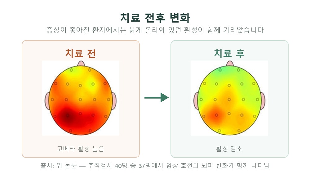 치료 전과 치료 후의 고베타 뇌파 활성 비교