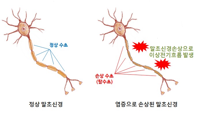 정상 말초신경과 염증으로 손상된 말초신경 비교 — 신경을 감싼 수초가 벗겨지면(탈수초) 신호가 새어 이상 전기 흐름이 생깁니다