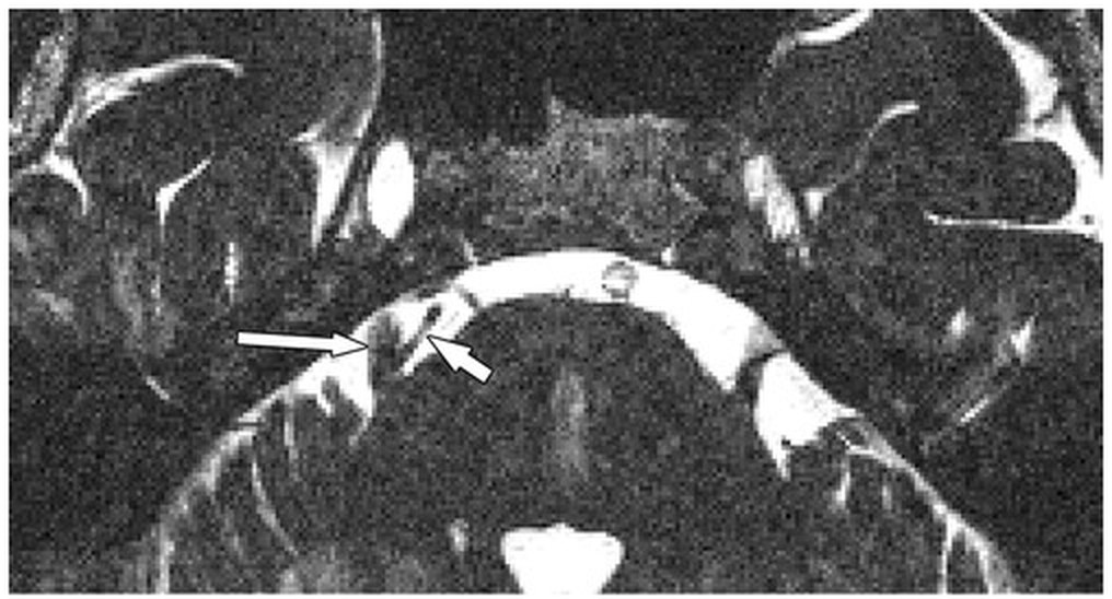MRI 영상 — 삼차신경(긴 화살표)이 옆을 지나가는 혈관(짧은 화살표)에 눌려 있는 모습