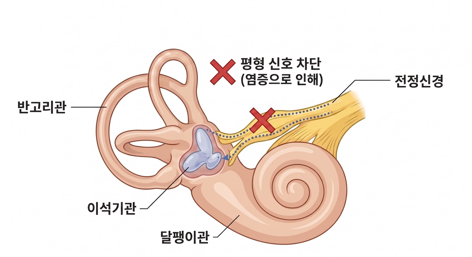 전정신경염에서 차단되는 평형 신호 — 전정신경에 생긴 염증으로 반고리관과 이석기관의 신호가 뇌로 전달되지 않습니다