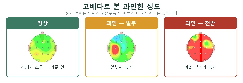 고베타(High Beta) 뇌지도 세 가지 — 전체가 초록인 정상, 일부만 붉은 경미한 과민, 여러 부위가 붉은 전반적 과민
