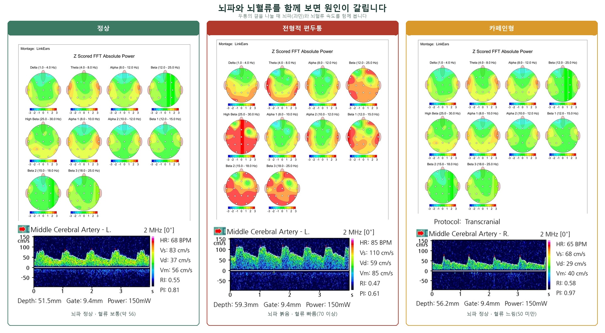 뇌파와 뇌혈류 조합 세 가지 — 정상, 전형적 편두통(뇌파 붉고 혈류 빠름), 카페인형(뇌파 정상이고 혈류 느림)