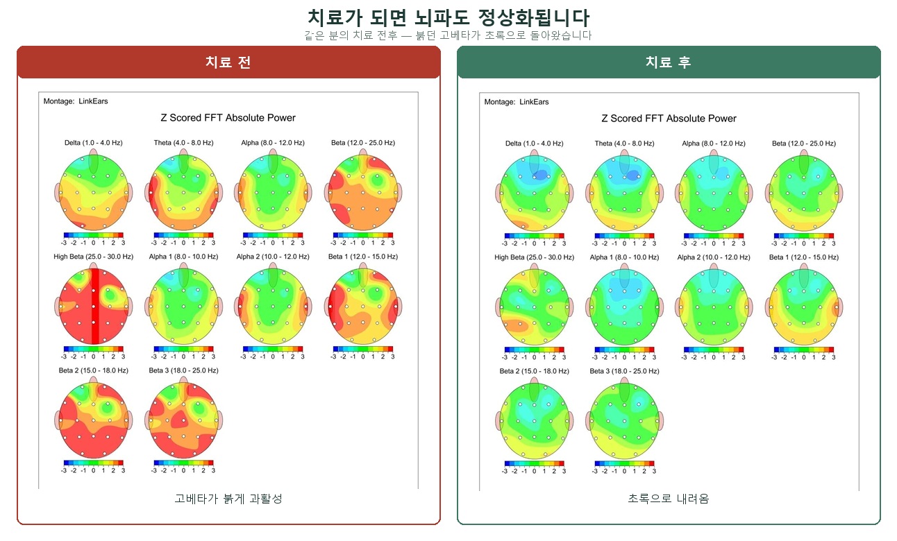 정량뇌파 치료 전후 — 치료 전 붉던 고베타가 치료 후 초록으로 정상화되었습니다