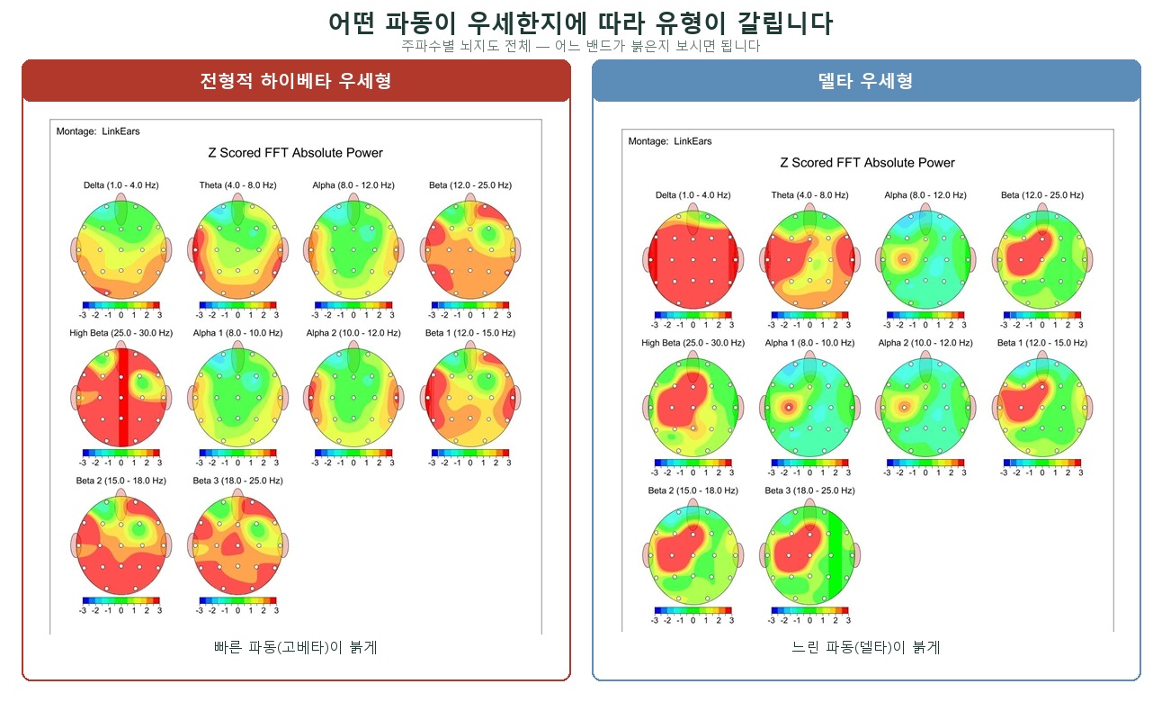 우세한 파동에 따른 두 유형 — 주파수별 뇌지도 전체에서, 빠른 파동 고베타가 붉은 전형적 하이베타 우세형과 느린 파동 델타가 붉은 델타 우세형